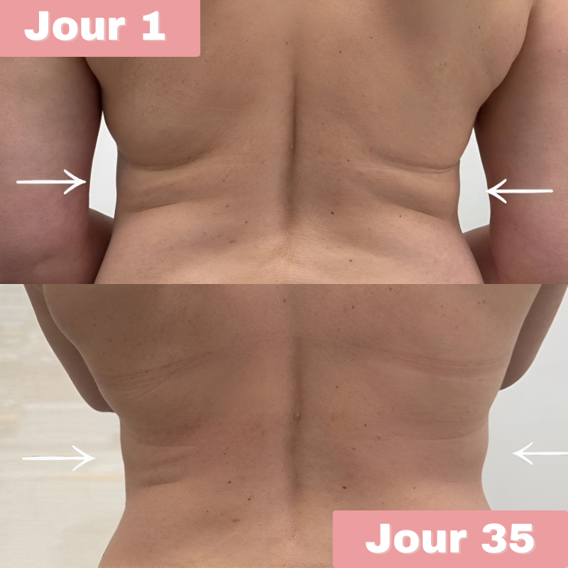 Sirolis : L'innovation anti-cellulite